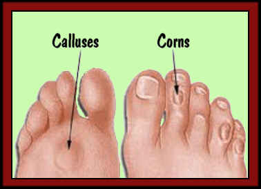 Callus vs corn